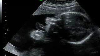 Baby Rowe 27 weeks  4D ultrasound