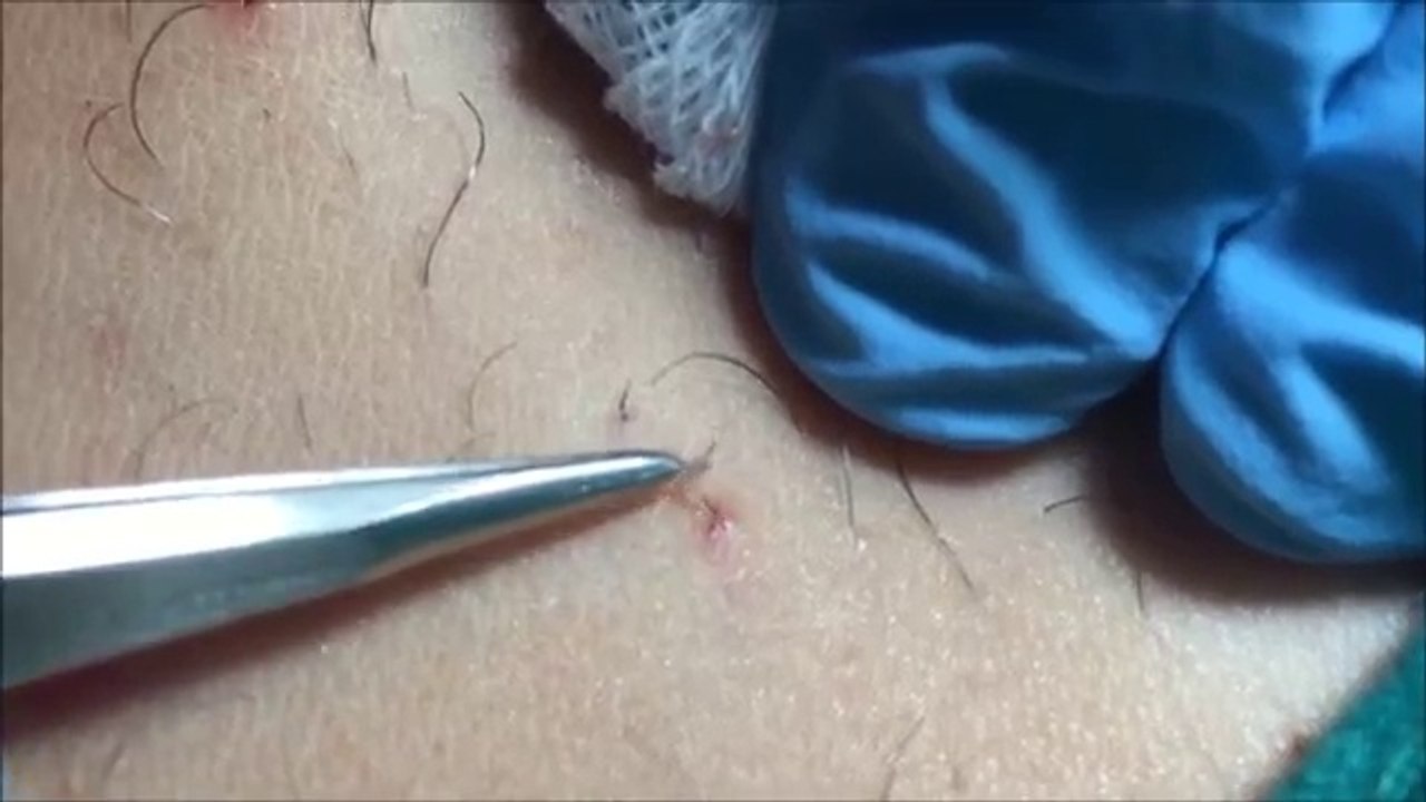Footage Of Doctor Removing Ingrown Hair Is Oddly Relaxing