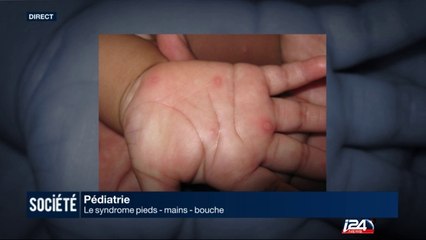 Pédiatrie : le syndrome pieds-mains-bouche