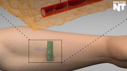 'Smart' Stitches Let Doctors Track How You're Healing