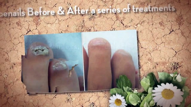 Laser Nail Fungus Treatment Victoria BC - Nail Fungus Remedy