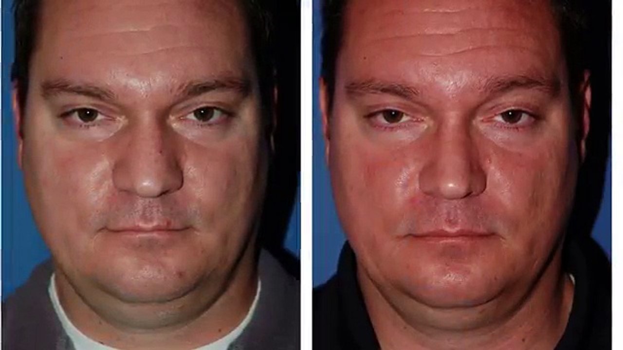 (206) 624-6200 Top Surgeon For Revision Rhinoplasty Surgery Seattle Washington