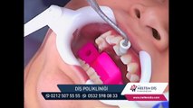 Ortodondi, Diş teli nasıl takılır?