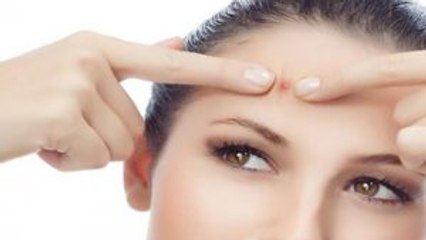 Acne -Who gets and causes