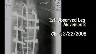 1st Observed Leg Movements - Clark 2/22/08