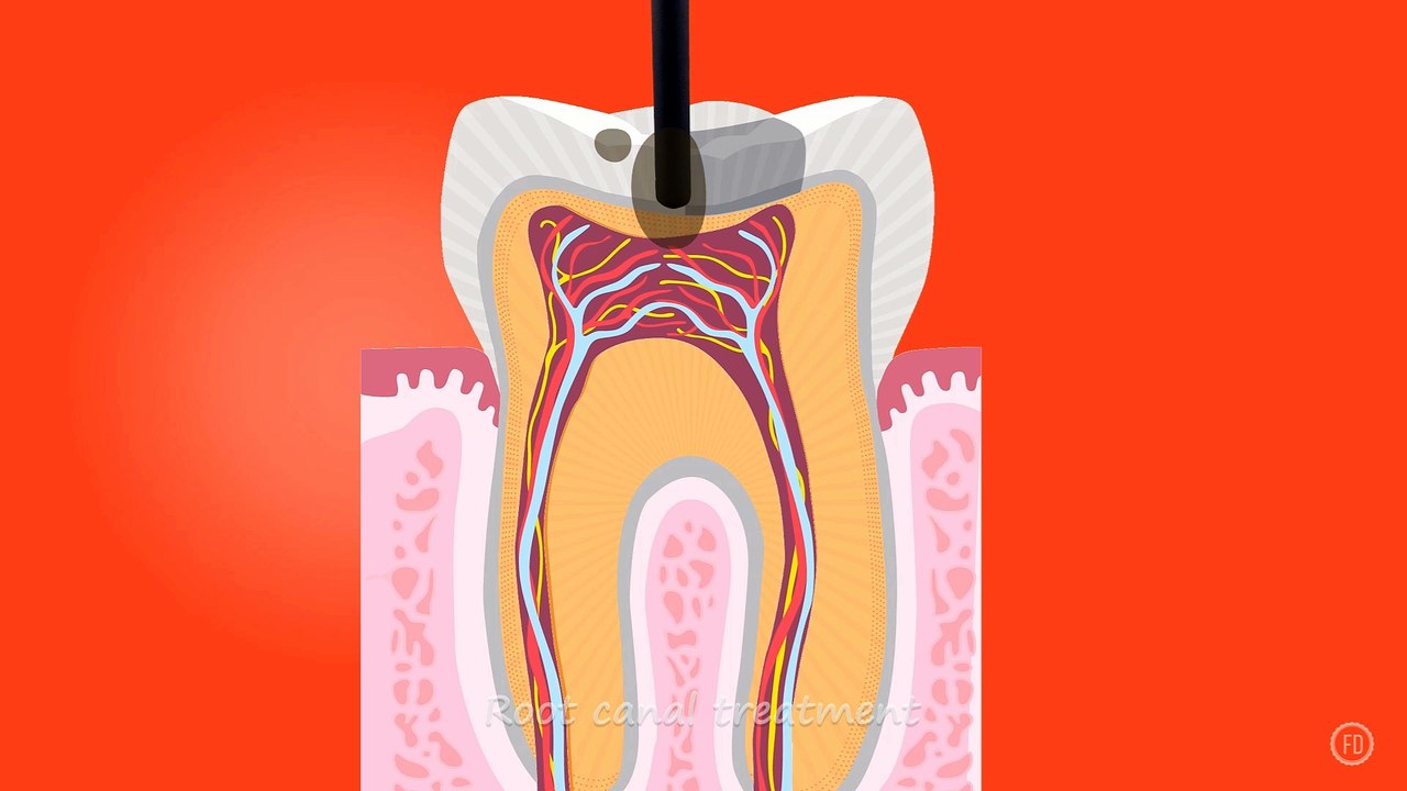 Root Canal Treatment | Medical Education | HD Video | F1 Digitals