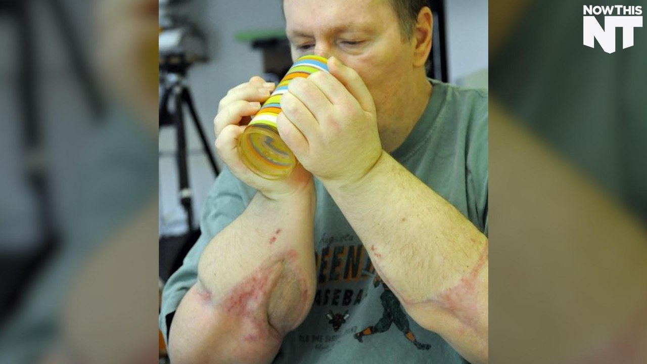 First-Ever Double Hand Transplant Patient Cannot Use His Hands