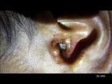 He Went In Complaining About Ear Pain… What The Doctor Discovers Shocked Them Both.