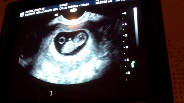 9 weeks 6 days ultrasound - baby moves!