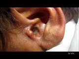 He Went In Complaining About Ear Pain… What The Doctor Discovers Shocked Them Both.