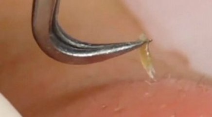 Sivilcesiz Bir Yüz İçin Bunu Yapar mıydınız?