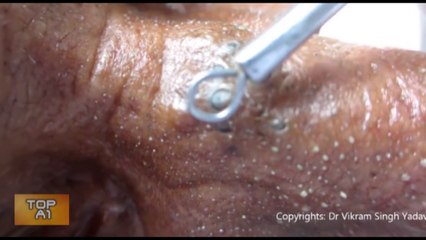 TOP 5 Espinillas y Granos Mas Impresionantes