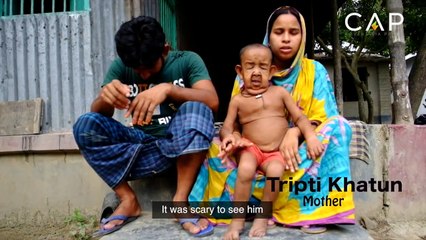 A 4 ans, ce petit garçon malade ressemble à un vieillard