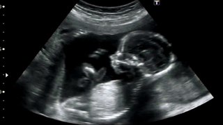 Baby Heartbeat On Ultrasound Sound Effect