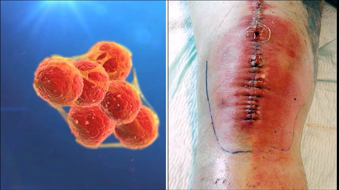 Biofilm-assoziierte infektionen