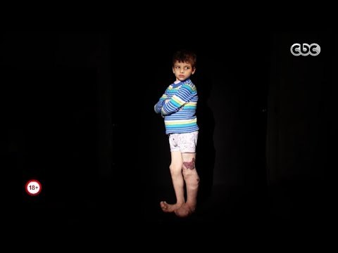 حصلت قبل كده | شاهد طفل مصاب بمرض نادر أصيب به 15 شخص فقط حول العالم