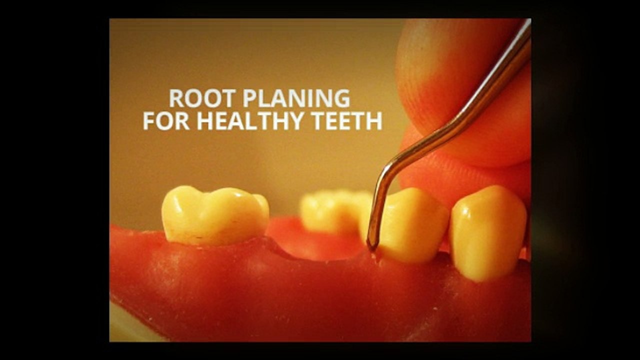Root Planing For Healthy Teeth