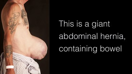 If You Have Hernia It’s Best To Get Rid Of It Immediately