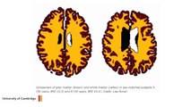 Study Finds Brains Of Obese Individuals A Decade Older Than Those Of Lean People