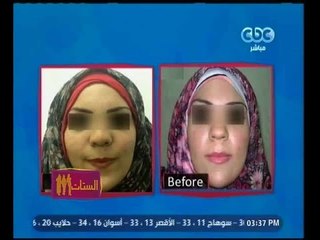 الستات مايعرفوش يكدبوا | الفقرة الطبية |  "تجميل الأنف"