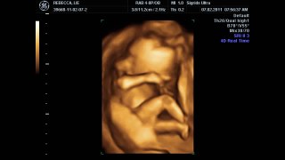 19 weeks ultrasound images and short 4D video at the end