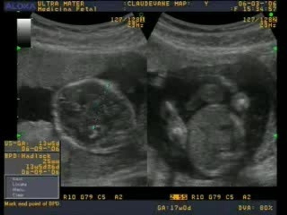Ecografia semana 17
