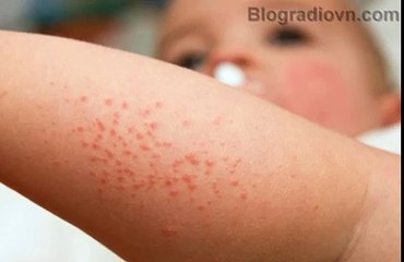 Tư vấn trị rôm sảy cho trẻ nhỏ trong mùa nóng