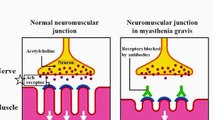 Myasthenia Gravis I USMLE Recently Tested Topic