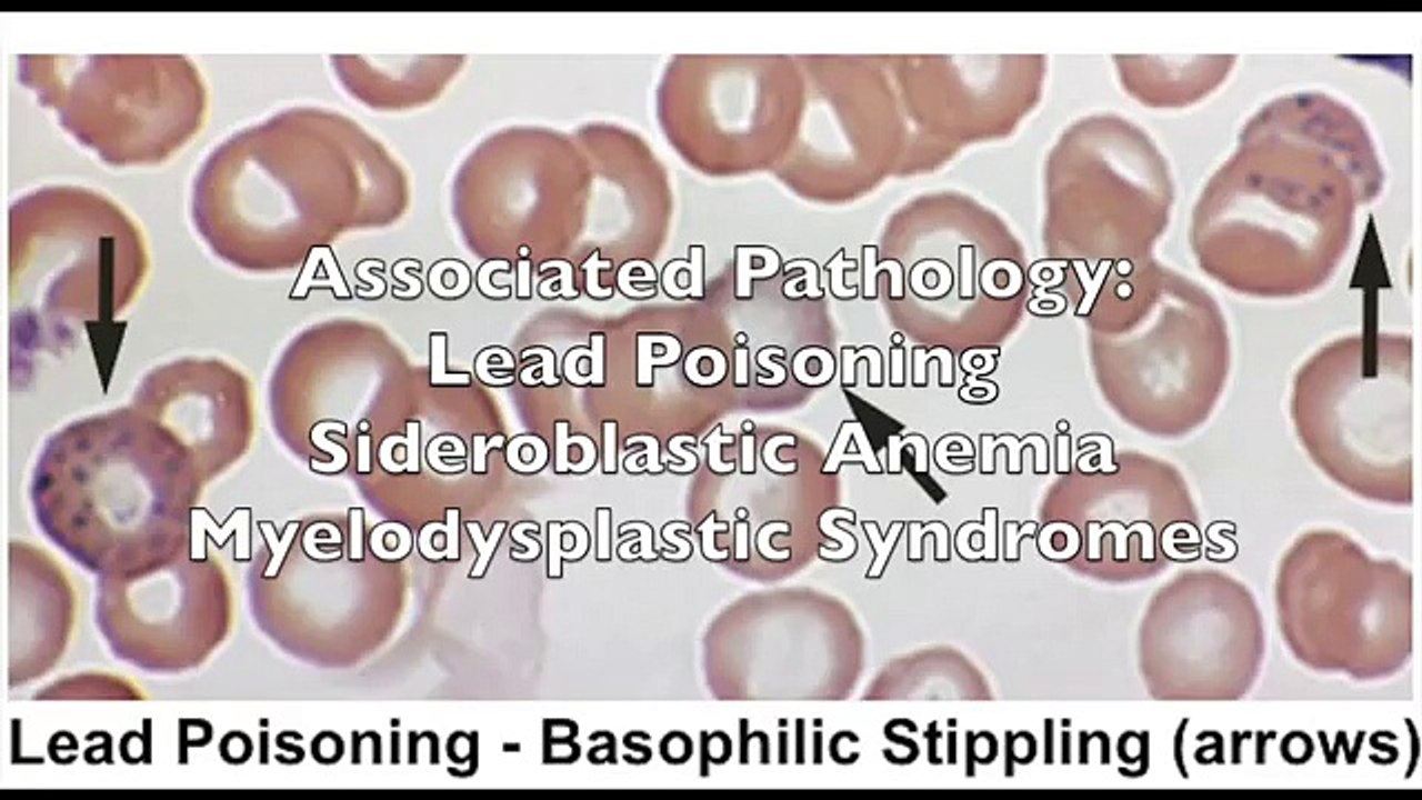 USMLE Highly Tested Topic: Few High-Yield Pathologic RBC Forms only