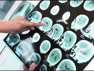 Ultrasound implant can help chemo drugs reach brain tumors