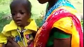 How a Nagada child appears due to malnutrition
