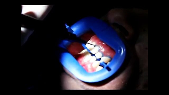 Diş Beyazlatma Nasıl yapılır - Diş Beyazlatma fiyatları