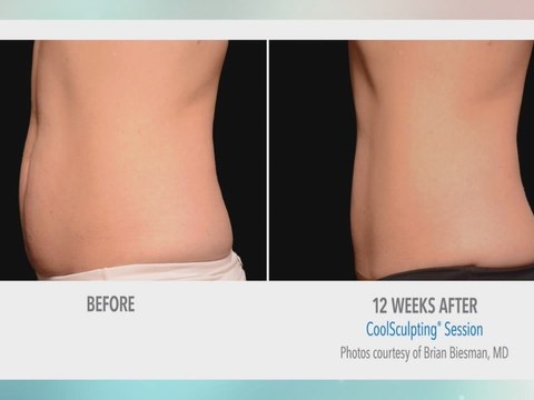 Precise Body talks about freezing fat