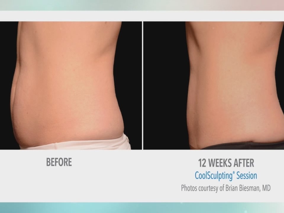 Precise Body talks about freezing fat