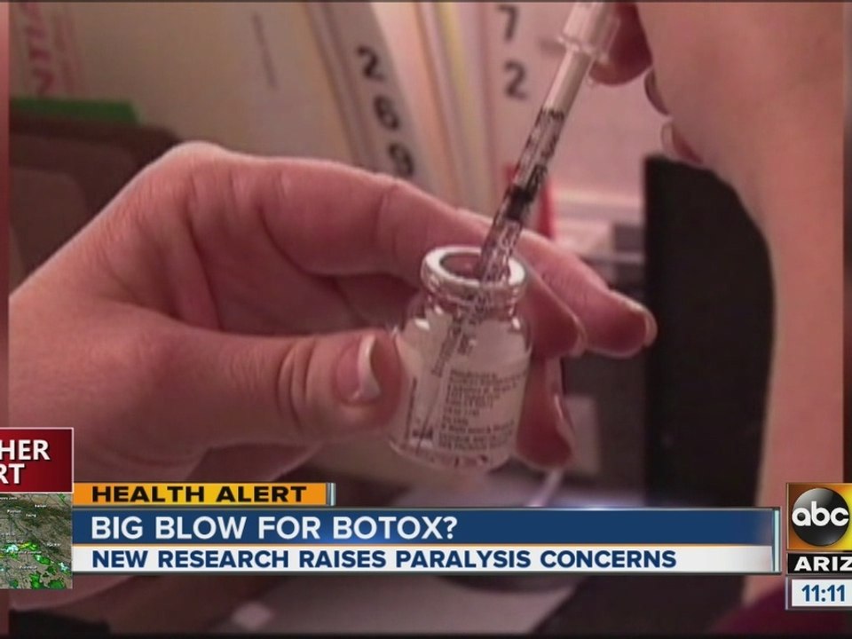Research raises concern on botox treatments