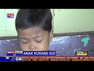Bocah di Padang Derita Gizi Buruk