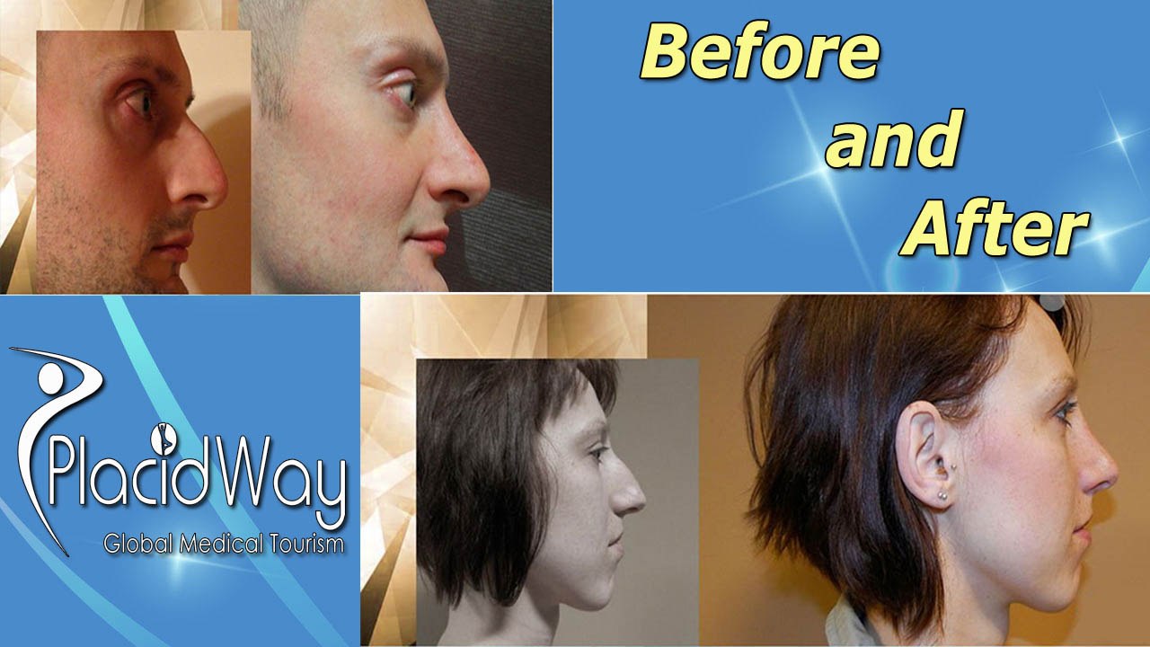 Before and After Nose Job Surgery in Czech Republic Europe