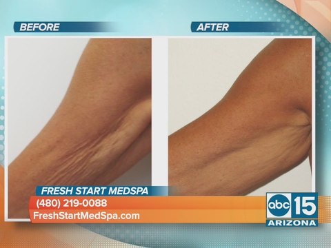 Fresh Start MedSpa shows off their newest technology for skin tightening