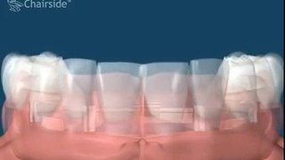 Протез на имплантах при полном отсутствии зубов