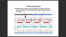 Obstructive Sleep Apnea Syndrome (OSAS) & Sleep Study ✔