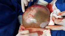 Rare Twin Birth Inside Amniotic Sac