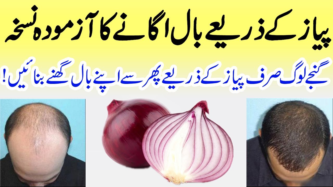 Pyaz Ke Zariye Baal Ugane Ka Azmooda Nuskha - پیاز کے ذریعے بال اگانے کا آزمودہ ںسخہ - YouTube