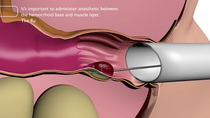 Contre les hémorroïdes : la procedure Rafaelo