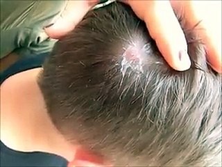 Cette femme enfonce une pince à épiler dans son cuir chevelu, mais ce qu’elle retire de sa tête est vraiment affreux !