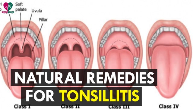 Natural Remedies for Tonsillitis - Health Sutra