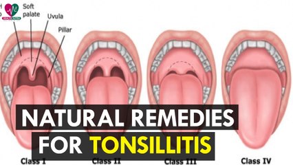 Natural Remedies for Tonsillitis - Health Sutra