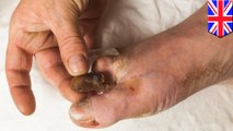 Man uses pliers to amputate gangrene-infected toes