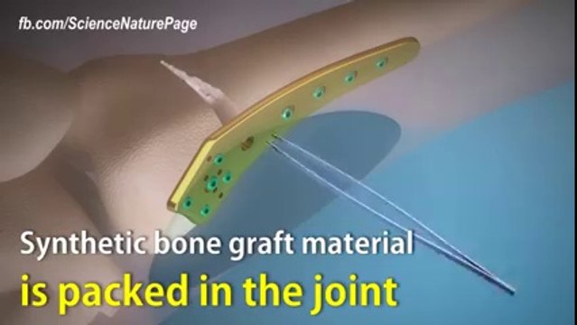 how surgeons perform knock-knee correction during surgery