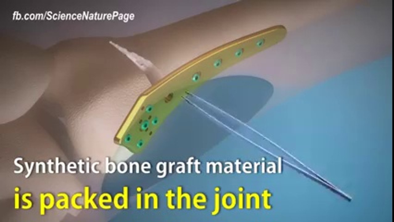 how surgeons perform knock-knee correction during surgery