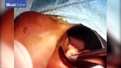 Un docteur retire 14 vers vivants de l'oreille d'un jeune garçon